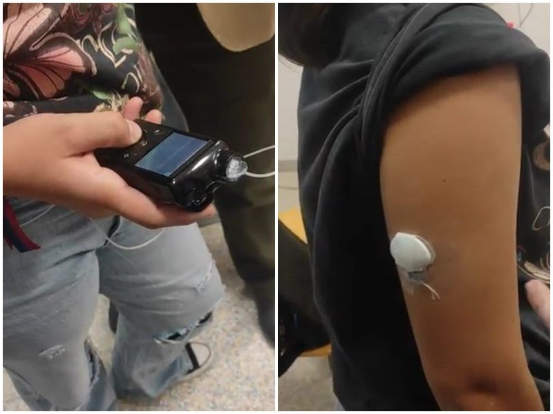 INGESA proporciona bombas de insulina a cuatro menores con diabetes
