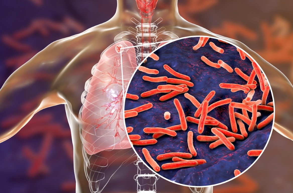 La tuberculosis registra un repunte de un 8,3% aunque sigue por debajo de los niveles de 2015